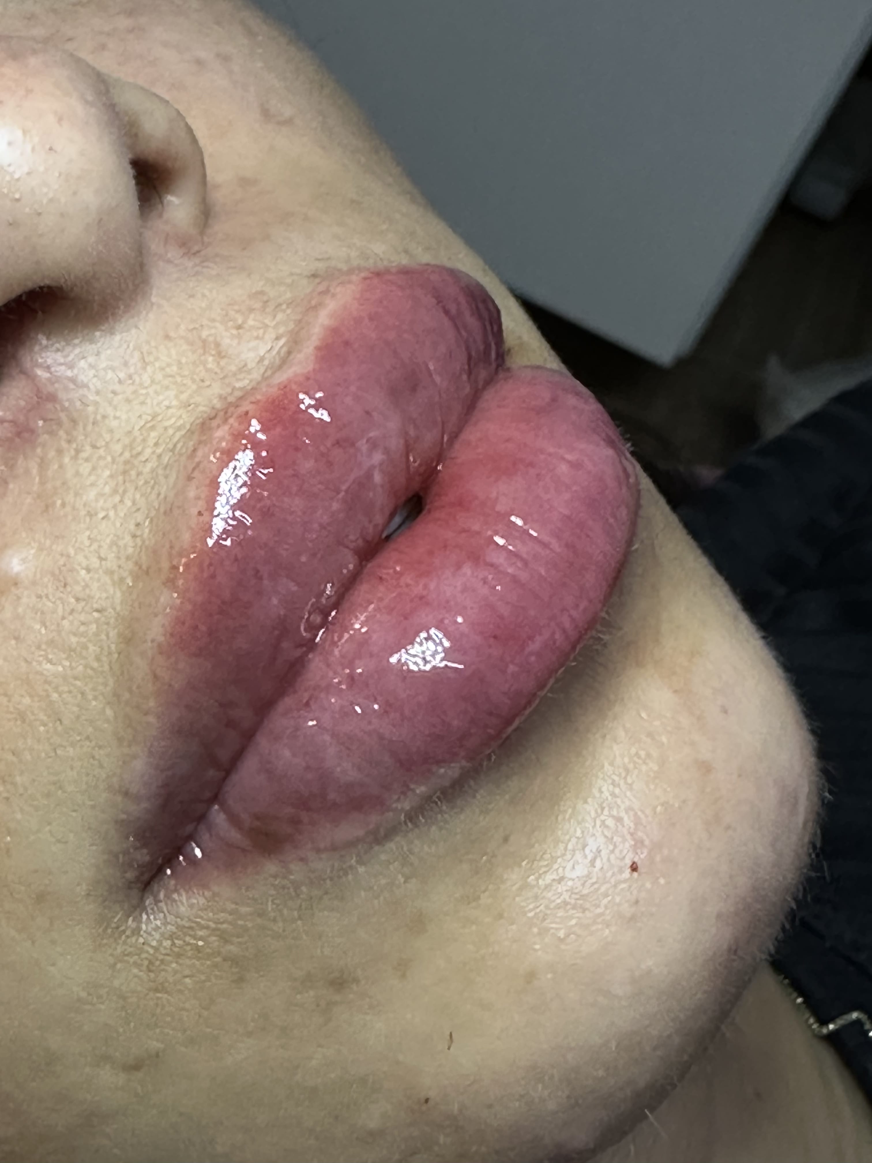 Preenchimento Labial