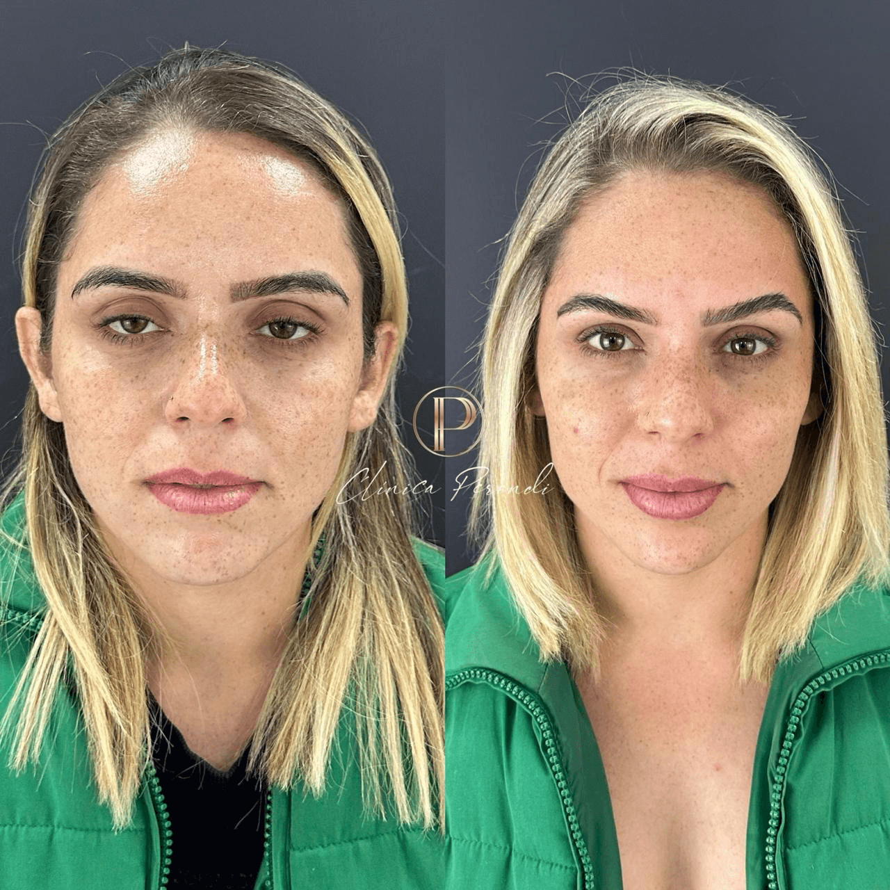 Harmonização Facial com plasma